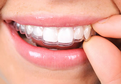 Alinhadores dentÃ¡rios removÃ­veis tipo Invisalign e Clear-Aligner 